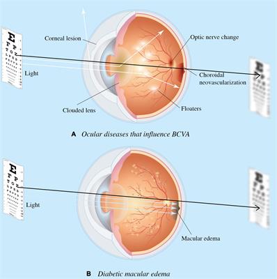Deep learning to infer visual acuity from optical coherence tomography in diabetic macular edema